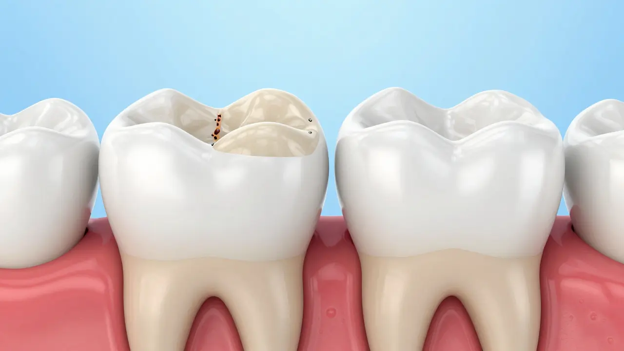 3D vizualizace srovnání klasické plombky a přesně sedící kompozitní inlay.
